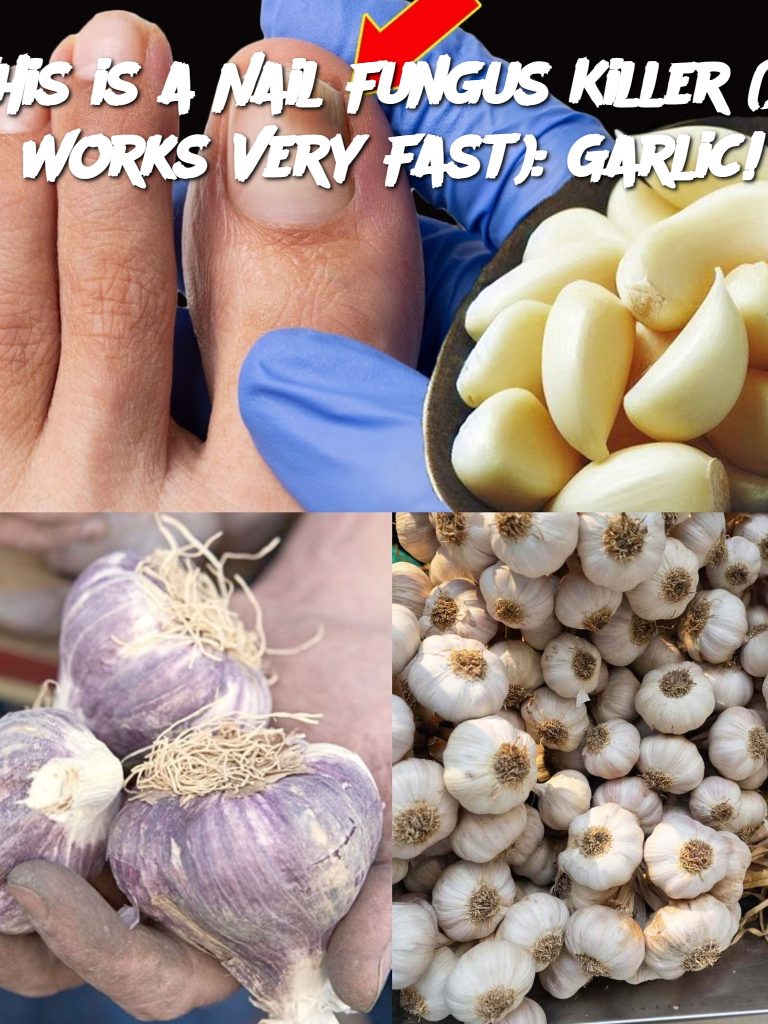 This is a Nail Fungus Killer (It Works Very Fast): Garlic!