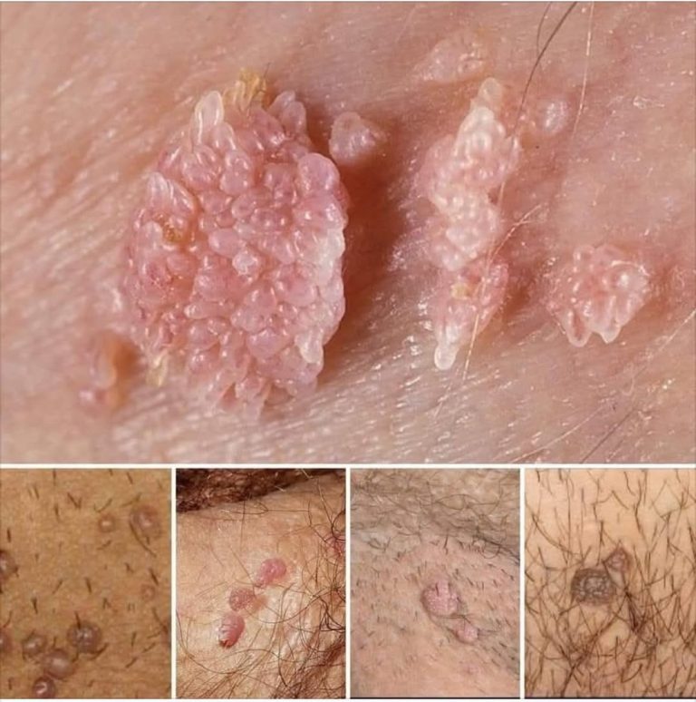 Zrozumienie wirusa, objawów i naturalnych środków zaradczych w walce z HPV