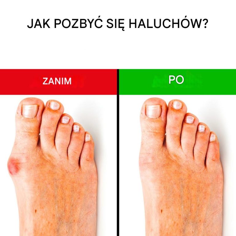 Jak pozbyć się haluksów?