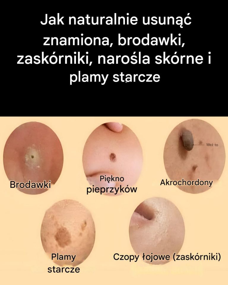 Naturalne środki zaradcze na leczenie narośli skórnych, brodawek i zaskórników
