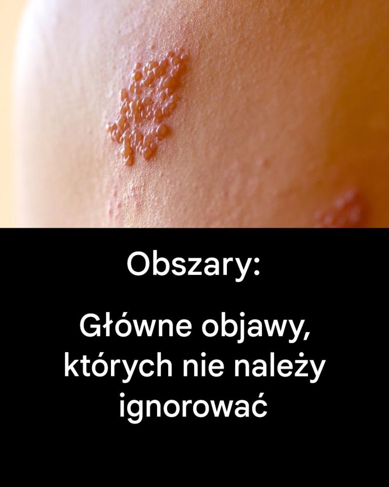 Półpasiec: objawy, powikłania i profilaktyka
