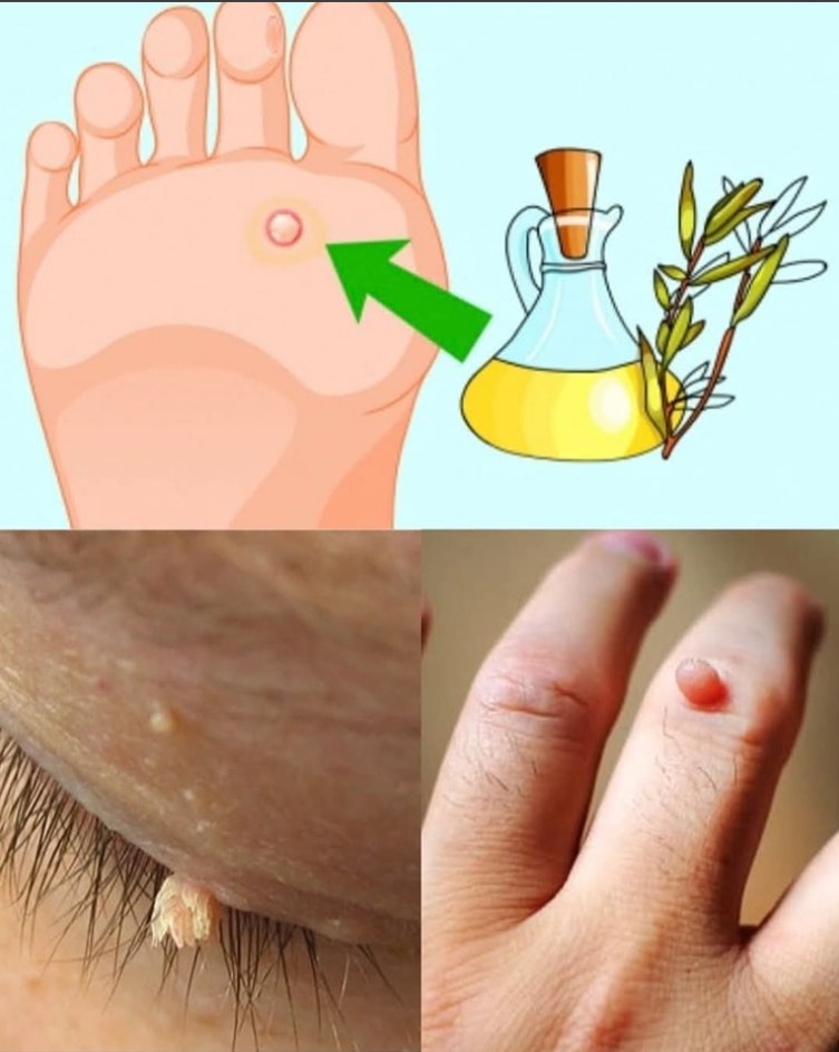 Tytuł: 8 niesamowitych korzyści cytryny i imbiru – naturalny sposób na usuwanie narośli skórnych