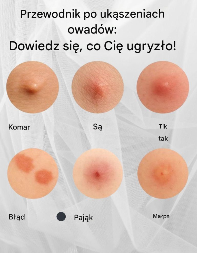 Rozpoznaj ukąszenia: Rozpoznaj najczęstsze ukąszenia owadów