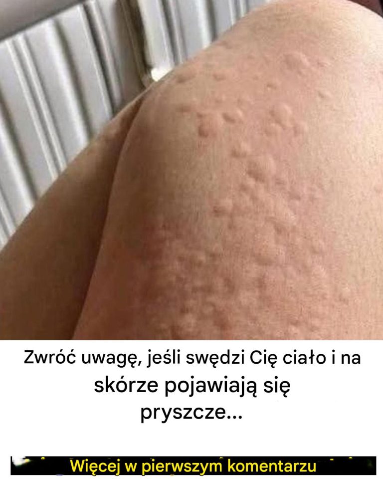 Dlaczego na skórze pojawia się pokrzywka? Oto zaskakujące czynniki, o których możesz nie wiedzieć.