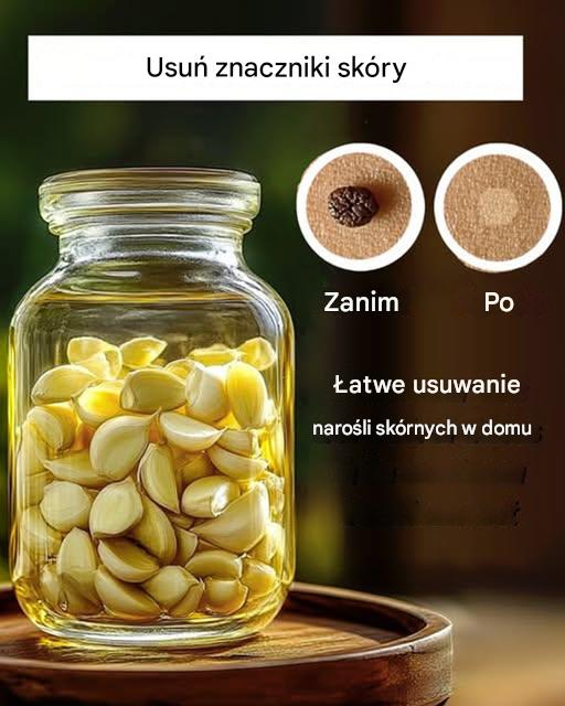 3 domowe sposoby na pozbycie się narośli skórnych