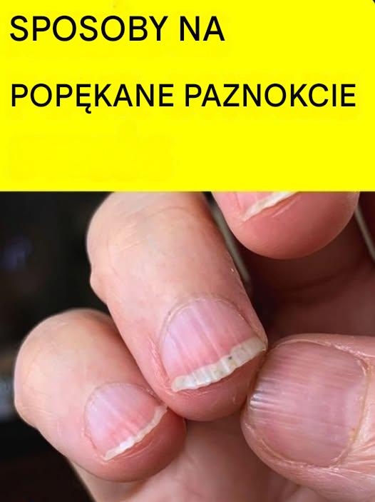 Paznokcie prążkowane: przyczyny, znaczenie i naturalne rozwiązania