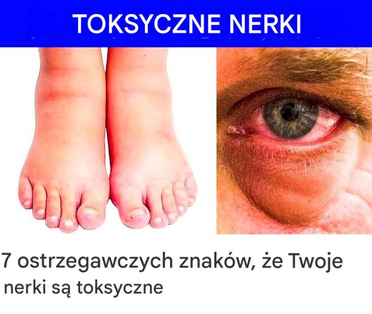 7 ostrzegawczych oznak, że Twoje nerki są toksyczne