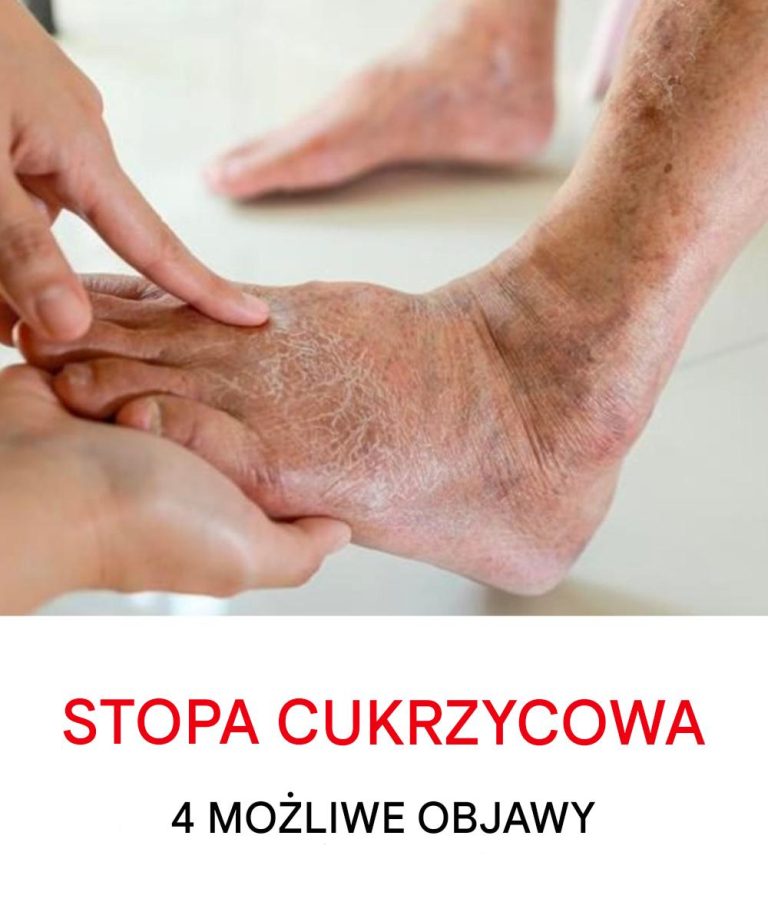 Stopa cukrzycowa: czym jest i jak leczyć jedno z najpoważniejszych powikłań cukrzycy