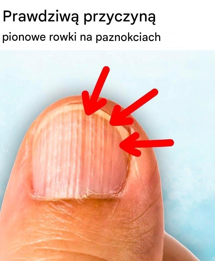 Prawdziwa przyczyna pionowych bruzd na paznokciach